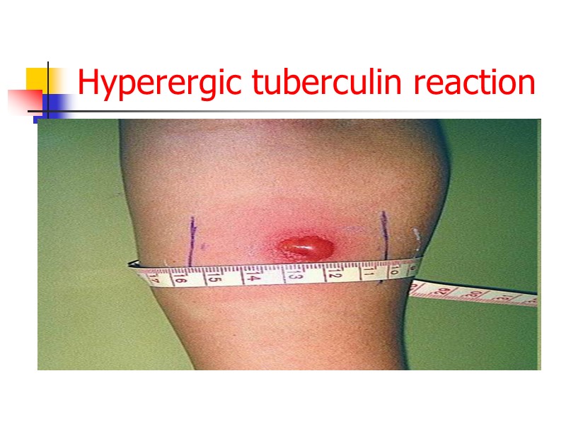 Hyperergic tuberculin reaction